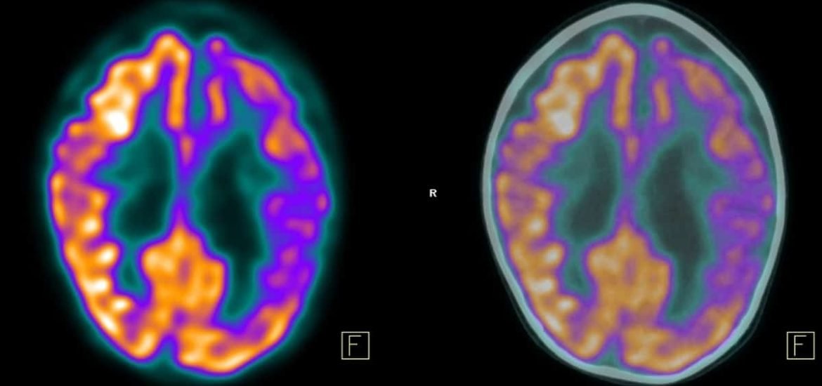 Speeding up the diagnosis of Alzheimer’s disease with artificial intelligence