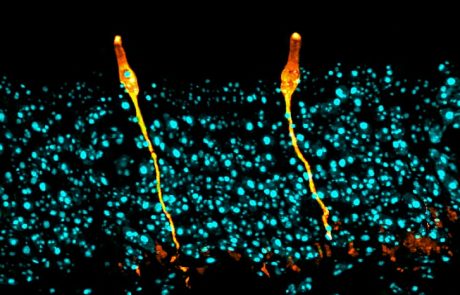 New lung cell type discovered that plays a key role in cystic fibrosis